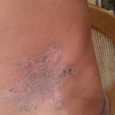After 12 treatments