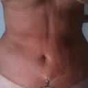Two Weeks Post OP