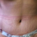 Sorry it's not clearer. But this is 3 days PO. Got some swelling going on but looks pretty good!