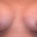 DAY 8 PO: after stitches taken out. Allergan silicone--Right:325cc Left:300cc