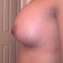 DAY 8 PO: Left 300cc Allergan silicone