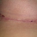 Quick snapshot of scar under breast. Been rubbing cocoa butter and arnica gel twice a day to help with swelling...