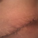 Closeup of the right side of the scar (day 8 PO)