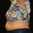 Before Coolsculpting--hard to look at :(
