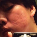 June 28, 2012 - Two months after procedure

This is the right side of my face (reflected in a mirror) given the worst possible lighting.