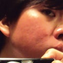 June 28, 2012 - Two months after procedure

This is the left side of my face (reflected in a mirror) given the worst possible lighting.