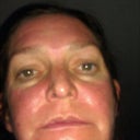 photo of swelling