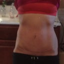 Scar postop 6 wks