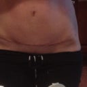 Scar postop 6 wks