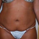 Physicians before pic front view