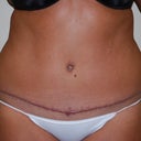 Physicians after pic 4 months post op...not happy about that scar!!