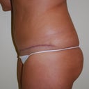 4 months post op physicians pic