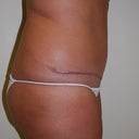 4 months post op physicians pic