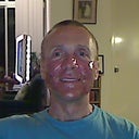 2.5 days after procedure.