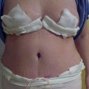 2 days post-op. What a difference 6 lbs removed has made. More than my 100 lb weight loss!