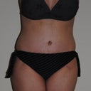 2 weeks post-op...very swollen! Had to get a bikini shot! :-)