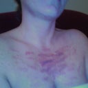 You can see the laser burns on the day of the procedure. They were purple water blisters that took months to heal. When they did heal, I was left with white/hypopigmented scars in the exact spots that were purple in this picture.