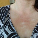 Hypopigmentation a full 2 years after the laser procedure. I am told these are permanent and there is nothing that can be done to fix them. Connie Groves scarred me for life under the medical director Dan Hightower and his wife, Terri Hightower, the manager of Dermess Renewal in Nashville, TN.