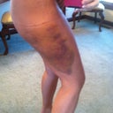Lipo...ouch