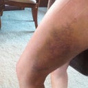 still so bruised day 6 post op