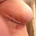 Side view..post op 3 days