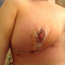 righty, 3 days post op