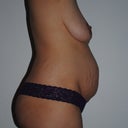 Right side (night before surgery)
36 DD breasts