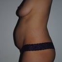 Left side (night before surgery)
36 DD breasts