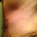POST OP DAY 8