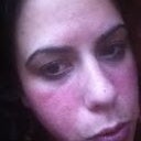 trying to get a close up,  3rd day second fraxel, really starting to see results today skin very uneven not fully peeled yet!