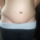 One month post op front
