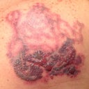 immediately after 4th treatment