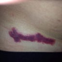 immediately after 4th treatment