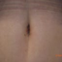 9 days post op Belly Button