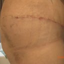 9 days post op