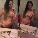 before tt, and 1 month post op (: