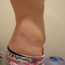 Still have bump on right side