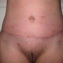 4 weeks post op