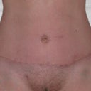 8 weeks post op
