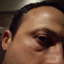 Hyaluronidase was added to remove Restylane Now have Indents under both Eyes from Hyalurondase. Don't let these Doctors use that and 5Fu/Steroids in your Face. They will remove Natural tissue. These Doctors have NO Clue what they're Doing. They made it sound like they know what they're doing. And after you get a Problem from what they did they say it wasn't from what they did.