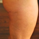 close up right lateral top of thigh