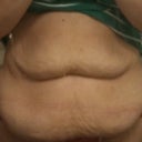 This is my tummy the day before sugery.