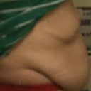 This is the side view the day before surgery.