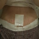 This is one day post op.