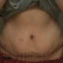 This is 9 days post op.