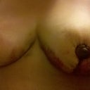 3 days after Breast Reduction