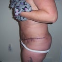 sideview hours after surgery