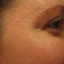 wrinkles and little pock-like marks all over the eye and cheeks, only week 8 now and getting worse.