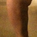 SIDE 6 months post but PRE-touch-up (-35 lbs from pre)