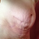 Before: belly